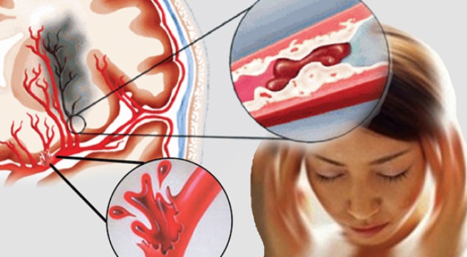 Cảnh giác đột quỵ não khi giao mùa